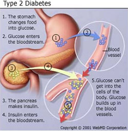 Type 2 diabetes