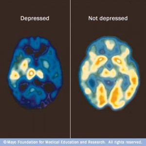 A PET scan can compare brain activity during periods of depression (left) with normal brain activity (right). An increase of blue and green colors, along with decreased white and yellow areas, shows decreased brain activity due to depression.